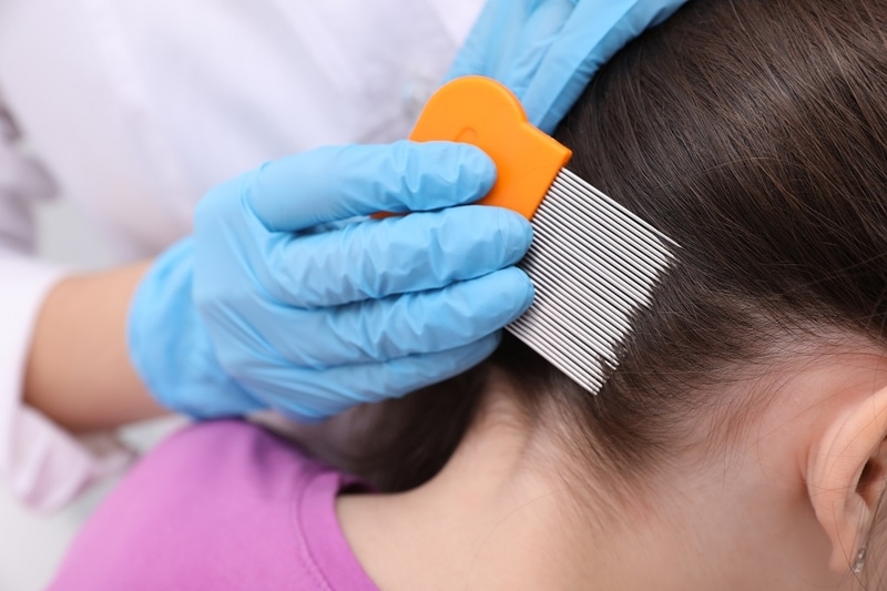 Lice in Curly Hair Can You Get It and How to Treat It? LiceDoctors